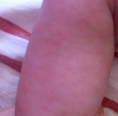 第三代代孕宝宝为什么会起湿疹